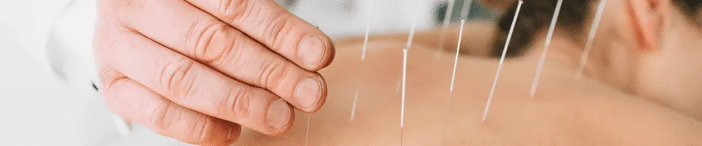 Patient Receiving Acupuncture Treatment in a Chiropractic Massage Clinic