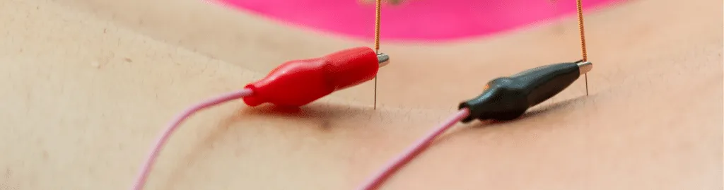 Electrical Acupuncture Therapy Being Administered in a Chiropractic Setting for Pain Relief